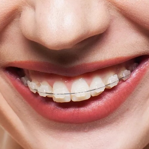 Керамические брекеты фото на зубах реальные фото