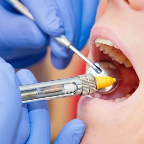 Лечение периодонтита зубов3